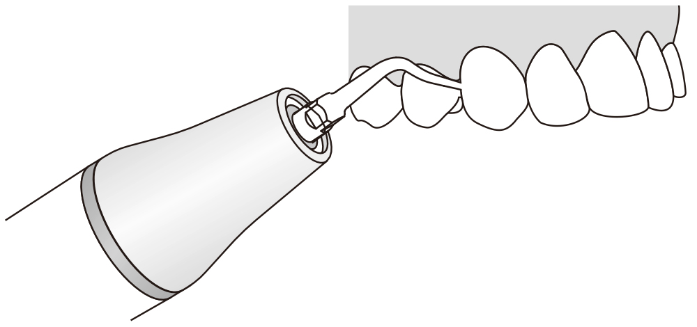 Сфера применения наконечника для скалера